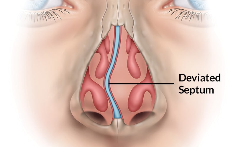 deviated septum surgery before and after