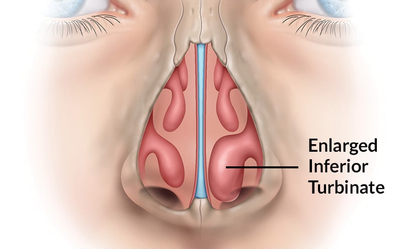 nasal anatomy turbinates