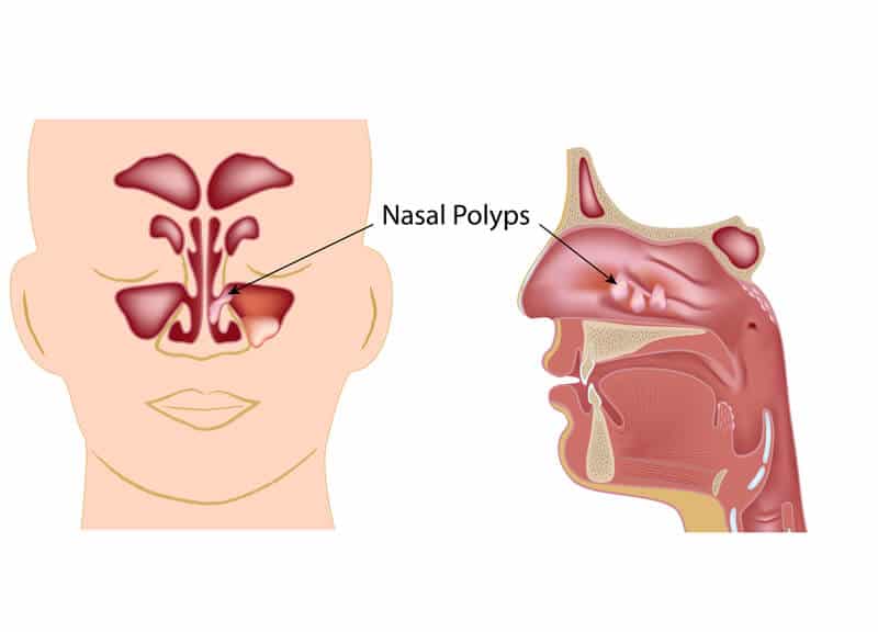 Why Can't I Breathe Well Through My Nose? (Nasal Obstruction and Chronic  Sinusitis)