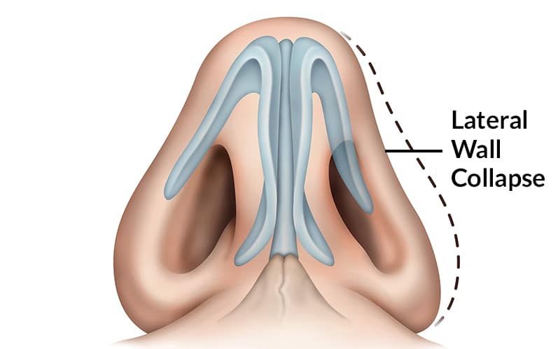 permanent nasal congestion