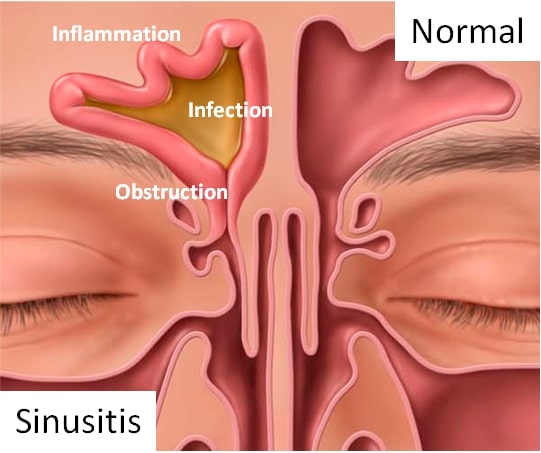 Could This Be the Answer to Your Sinus Problems? 